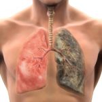Healthy Lung and Smokers Lung